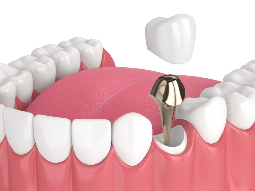 root canal in NEPA endodontist in Dunmore