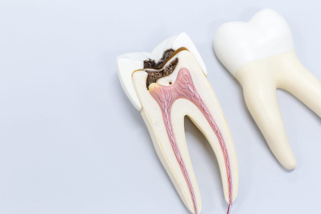 cracked teeth in Wilkes-Barre cracked teeth in Dunmore