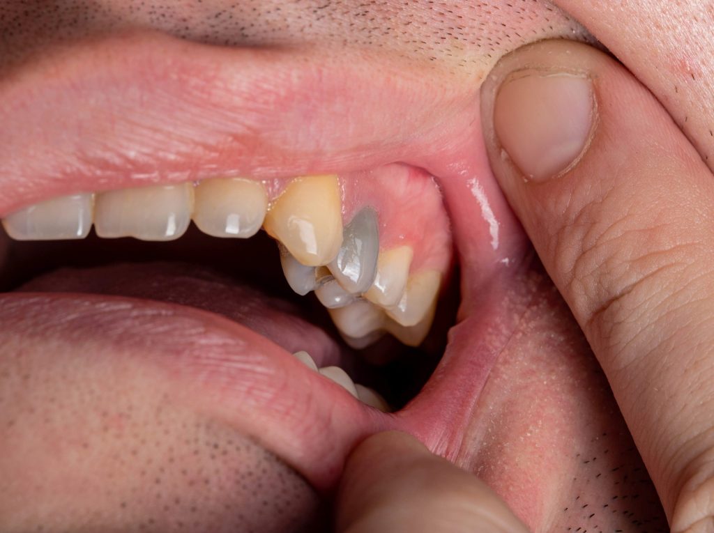 saving a tooth in Dunmore